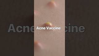 Acne Vaccine A Breakthrough in Skin Care Vaccine science medicine acne dermatology [upl. by Keir]