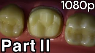 Part II Axial Reduction Full Metal Crown Preparation For Mandibular 1st Molar Lower 6 [upl. by Elleirbag]