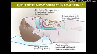 Hypoglossal nerve stimulation for obstructive sleep apnea [upl. by Dnarud128]