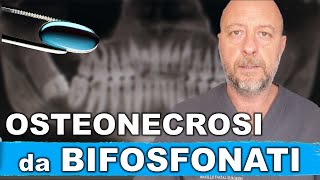 Osteonecrosi da bifosfonati tra gli effetti collaterali vi è la necrosi ossea [upl. by Yadnus]