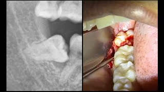 Extracción MUELA DEL JUICIO horizontal  Extracción de cordal incluido [upl. by Hudis477]