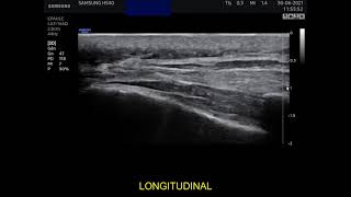 Ultrasound guided caudal epidural injection [upl. by Miltie759]