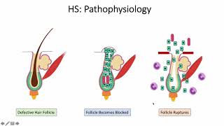 Hidradenitis suppurativa [upl. by Kawai]