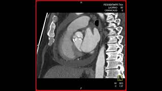 Constrictive Pericarditis [upl. by Dryden184]