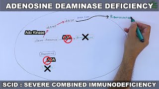 Adenosine Deaminase Deficiency  SCID [upl. by Ahsla]