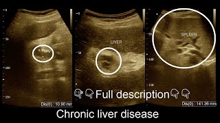 CLD  Chronic liver disease  Ultrasound  Report  Amader hospital  আমাদের হাসপাতাল [upl. by Adnawat]