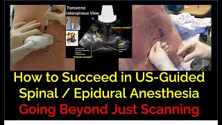 Keys to Success in USGuided Spinal  Epidural Anesthesia  Beyond Just Scanning [upl. by Hait]