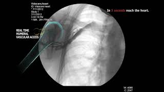 Intraosseous Infusion From Right Humeral Head [upl. by Sybley]