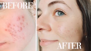 How I Cleared Up My Acne Tretinoin Doxycycline  Accutane  Big Sister Talks [upl. by Resneps]