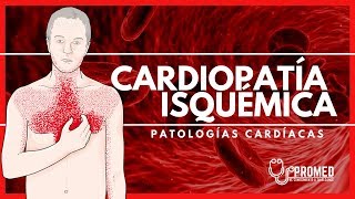 ✅ Cardiopatia Isquemica  Fisiopatologia Causas Factores de riesgo 🚬 Manifestaciones clinicas [upl. by Eema]