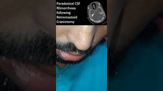 What is CSF Rhinorrhea Paradoxical CSF Rhinorrhoea brain braintumor neurosurgeon [upl. by Haze231]