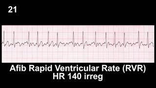 ECG Rhythm Recognition Practice  Test 1 [upl. by Yale788]