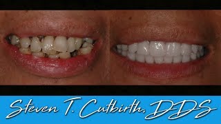 Extraction of Decayed Teeth amp Mini Implant Placement  Dental Minute with Steven T Cutbirth DDS [upl. by Addy]