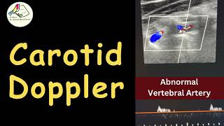 Carotid amp Vertebral Doppler  Carotid Atheroma Abnormal VA  Case story [upl. by Eahsat]