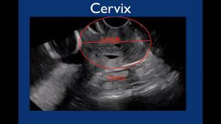 Pelvic Ultrasound [upl. by Aicirtal]