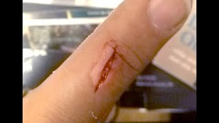 30 days wound healing time lapse [upl. by Allanson572]