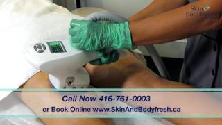 Cellulite Treatment with Ultrasonic Cavitation at Skin amp Bodyfresh [upl. by Mayce]