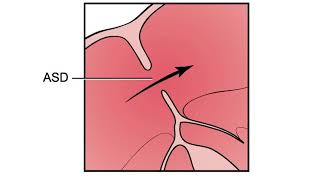 Preparing for the Cath Lab PFO ASD Closure  Heart Care Video Series [upl. by Assenyl563]