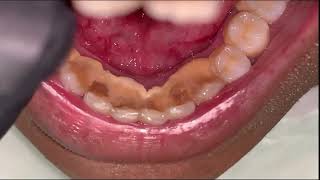 Limpieza de Sarro Dental Supragingival y Subgingival [upl. by Boyse]