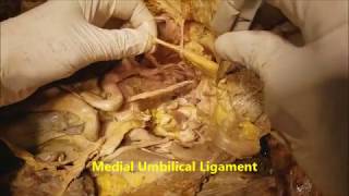 Pelvic Narrative Surgical Dissection  Iliac Artery Branches  Sanjoy Sanyal [upl. by Mchail725]