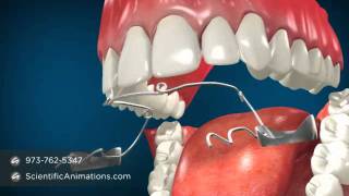 Jaw Surgery for Teeth Alignment  Fixing Jaw Braces [upl. by Forras]