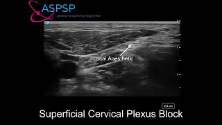 Ultrasound Guided Superficial Cervical Plexus Block [upl. by Novrej]