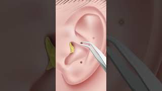 ASMR Ear Cleaning Animation  Oddly Satisfying ear stone removal  shorts [upl. by Adiell]