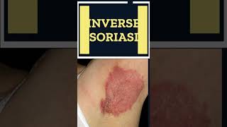 5 Types of Psoriasis You Do Not Know  Shorts [upl. by Auoh]