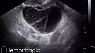 case 609 Hemorrhagic corpus luteum cyst CLC [upl. by Daile]