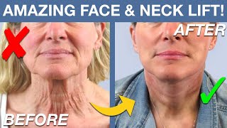 Facelift Results You WONT Believe Lower Face amp Neck Lift Before and After [upl. by Redan]