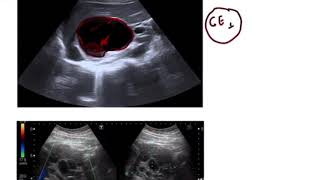 Hydatid Cyst of liver STAGING [upl. by Iruam]