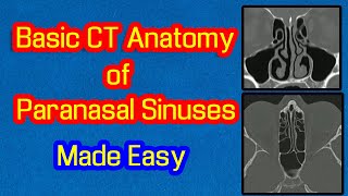 Basic CT Anatomy of Paranasal Sinuses Made Easy [upl. by Pedaias]