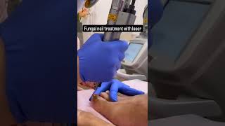 Fungal nail treatment with laser  By Dr Chandni Jain Gupta  shorts expertdermatologist [upl. by Ylloh364]