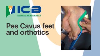 Pes Cavus feet and orthotics [upl. by Amir736]