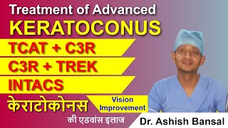 Advanced Keratoconus Treatment C3R Plus TCAT with C3R TREK INTACS  Keratoconus Surgery [upl. by Ahseyd]