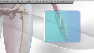 AllDorsal Scapholunate Reconstruction With InternalBrace™ Ligament Augmentation Repair [upl. by Ylicis998]