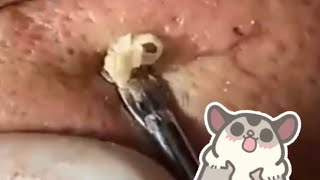 Navel Stone Popping Popaholics amp Dermatology [upl. by Ihsorih]