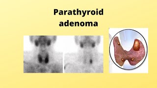 parathyroid adenoma [upl. by Tebzil138]