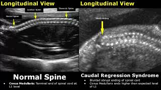 Fetal Spine Ultrasound Normal Vs Abnormal Image Appearances  Spinal Abnormalities  Obstetric USG [upl. by Ridgley]