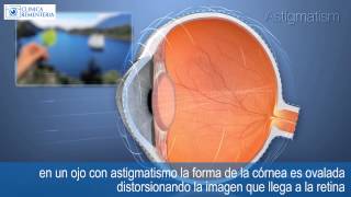 Astigmatismo  OptiLASIK cirugía refractiva 100 láser [upl. by Narf]