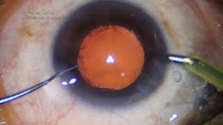 99 Phaco in mid dilated pupil  DR PL [upl. by Einohpets649]