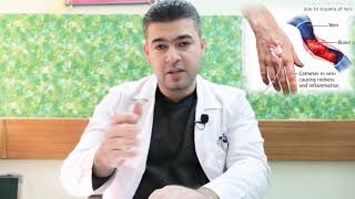 Thrombophlebitis التهاب الوريد الخثري [upl. by Strait]