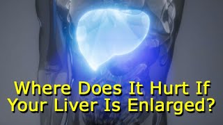 Where Does It Hurt If Your Liver Is Enlarged [upl. by Schifra53]