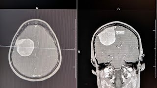 What is Dizziness  PACEHospitals shorts dizziness vertigo viral [upl. by Aneerol10]