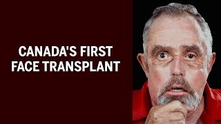 The story behind Canadas first face transplant [upl. by Jenks]