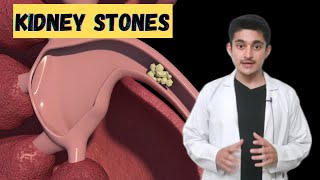 Kidney stones Renal calculi 3d animation  symptoms pain types treatment  how are they formed [upl. by Reivax]