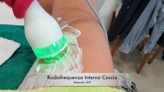 Radiofrequenza Interno Coscia  Metodo AIP [upl. by Lyman514]