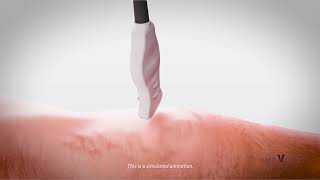 EVLT Laser Treatment for Varicose Veins The Future of Varicose Vein Treatment Animation Video [upl. by Morice]