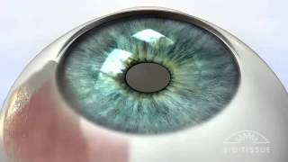 Pterygium Animation [upl. by Ahsihat41]