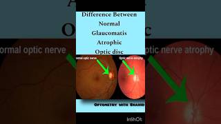 Difference between Normal Glaucomatous amp Atrophic Optic Disc opticdisc [upl. by Norha]